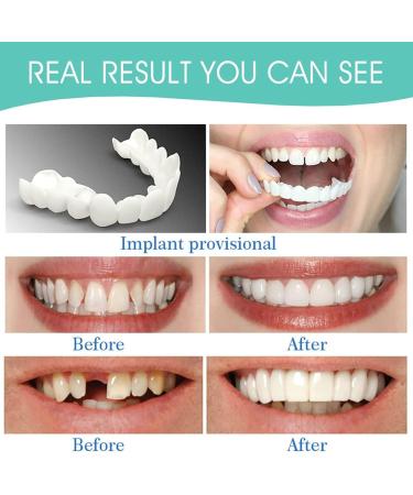 Tistik Cosmetic Veneers - 2 Pairs of Provisional Dentures & False Teeth for Men & Women - Instant Smile & Teeth Whitening - Buy Online on SooperMarket.com