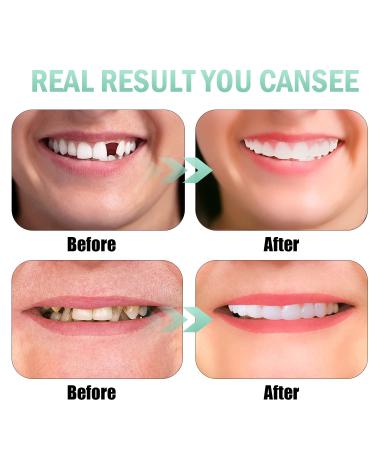 2 PCS Veneers Dentures Socket for Women and Men - Temporary Tooth Repair | Bright White Dental Veneers for Upper and Lower Jaw - Protect & Restore Your Smile - Buy Online on SooperMarket.com