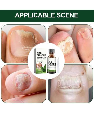 Nail Nourishing Solution | Multifunctional Nail Repair Drops | Nail Strengthening Drops | Hydrating Nail | Natural Nail Repair Remedy |-Infused Nail - Buy Online on SooperMarket.com