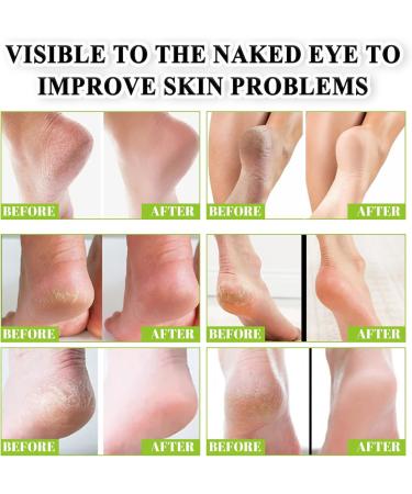 Urea 42% Foot Cream Cracked Heel Repair Cream For Feet and Hand Callus Remover For Dry And Hard Skin Hydrating Foot Moisterizer Nourishes Soften for Feet Knees Hand 100g - Buy Online on SooperMarket.com