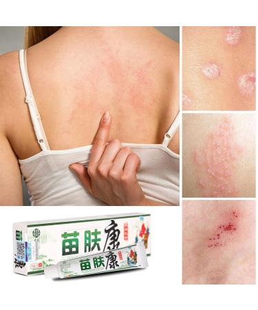 Herbal Anti-Itch Cream for Psoriasis, Dermatitis, Eczema - Multicolor, One Size - Buy Online on SooperMarket.com