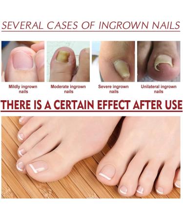 Ingrown Toenail Treatment Correction Drops Nail Growth Treatment Nail Care Ingrowing Toenail Treatment Ingrown Toenail Corrector Treatment for Ingrown Toenail Ingrowing Toenail Improve Toenail Health - Buy Online on SooperMarket.com
