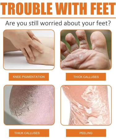 Foot Callus Removal Spray | Instant Peel Off for Cracked Heels & Dry Skin | Orange Oil Infused | Nourishing Foot Care (1PCS) - Buy Online on SooperMarket.com