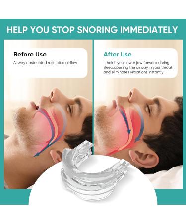 Anti-Snoring Mouth Guard - Comfortable & Adjustable Snore Device for Men/Women - Buy Online on SooperMarket.com