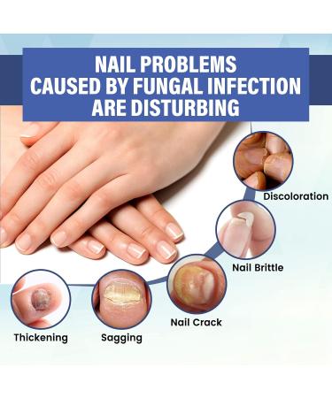 NailPro Nail Fungus LED Light Therapy Device Nail Fungus Laser Nail Fungus Treatment Home Use Nail-Fungus Remover for Toenail Fingernails & Onychomycosis (A01) - Buy Online on SooperMarket.com