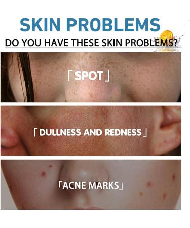 Acne Serum With Plant-Based Formula Dark Spot Correcting Glow Serum Dark Spot Serum Brightening Serum Hydrating Serum Improve Redness And Blemishes Smoothing & Calming Suitable For All Skin Types - Buy Online on SooperMarket.com