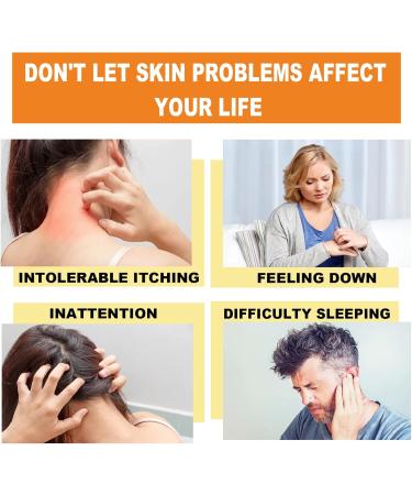 Bee Venom Cream for Psoriasis Cream Bee Venom Cream Psoriasis Treatment New Zealand Bee Venom Chinese Herbal Cream for Psoriasis Bee Venom Psoriasis Soothing Itching 20g (2) - Buy Online on SooperMarket.com