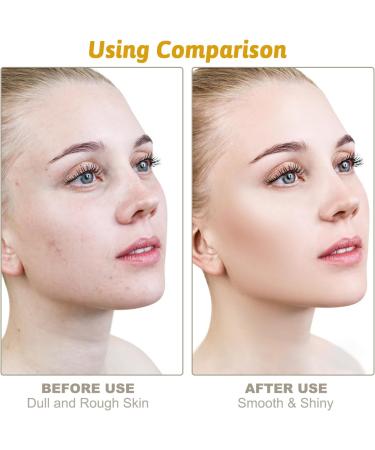 Niacinamide Face Serum 10% Niacinamide Serum + 1% Zinc Serum Face Moisturiser High Strength Vitamin Nourish Skincare Anti Aging Dark Spot Remover for Face Glow Skin Correcting (30ML) - Buy Online on SooperMarket.com