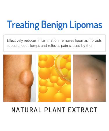 Lump-Free Lipoma Removal Ointment - Natural Vegetable Formula for Anti-Swelling & Skin Care - Hyper Havoc (White, One Size) - Buy Online on SooperMarket.com