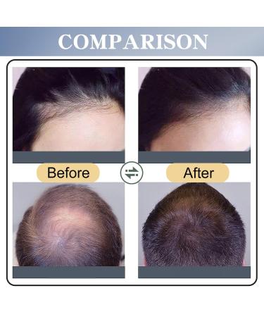 Buy 5% Minoxidil Hair Growth Spray for Men & Women | Anti Hair Loss Treatment | 2 Month Supply | Extra Strength Scalp Solution for Thicker Stronger Hair - Buy Online on SooperMarket.com