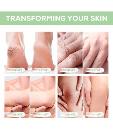 Urea Cream 40% with 2% Salicylic Acid - Foot Repair Lotion for Deep Moisturization & Exfoliation 5.29 Oz - Buy Online on SooperMarket.com