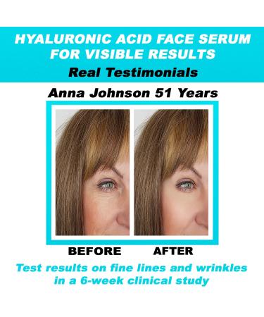 Pure Hyaluronic Acid Serum - Anti-Aging for Face Reduces Fine Lines Dark Spots & Hydrates Dry Skin - 2 oz - Buy Online on SooperMarket.com