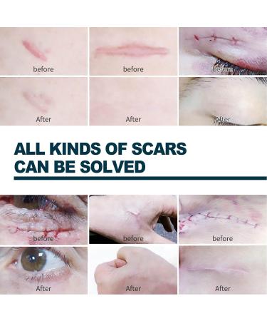Advanced Scar Gel 2Pcs 50ml - Stretch Marks & Scars Remover with Allantoin & Vitamin E - Hydrating & Smoothing Formula for Old & New Scars - Buy Online on SooperMarket.com
