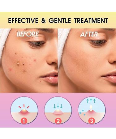 Acne Pimple Patches 96 Dots Colourful Spot Patches Hydrocolloid Patches Acne Patch Star Pimple Patches Cute Blemish Patches Acne Patches Spot Face Body Blemish Cover Skin Care - Buy Online on SooperMarket.com