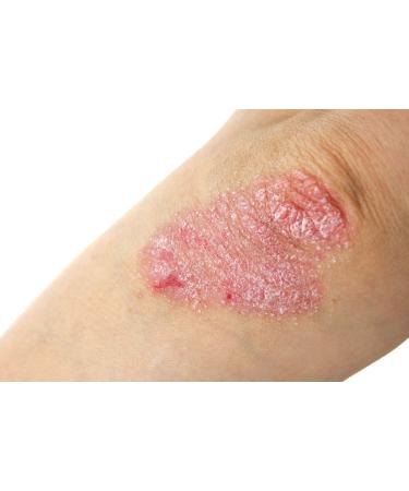 Blueline 10% Urea Cream 500ml | Body Cream for Very Dry Skin Psoriasis & Neurodermatitis | Itch Relief & Skin Care for Rashes & Blemishes - Buy Online on SooperMarket.com