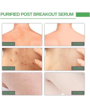 Trendyfave Dark Spot Correcting Glow Serum Skin Tag Removal Age Spot Remover For Face Scar Treatment Pore Minimizer Serums Skincare Contains Tea Tree Oil Vitamin E Body Acne Treatment 30ml - Buy Online on SooperMarket.com