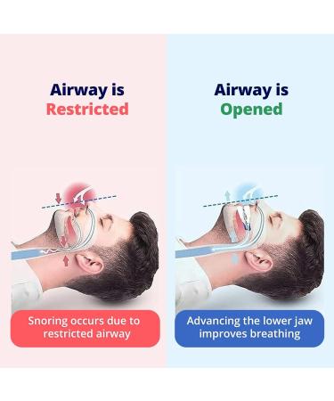 HanLynx Anti Snoring Devices with Chin Strap for Stop Snoring | Moldable BPA Free Soft Plastic Mouthpiece for Sleeping | Effective Snoring Solution Mouth Guard for Family - Buy Online on SooperMarket.com