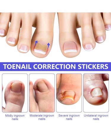 Toen il Correction Sticker 100Pcs: N il Repair P tches Restores Appearance of Discolored or Damaged Nails Foot Care - Buy Online on SooperMarket.com