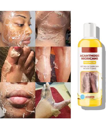 Extra Strong Peeling Oil - Chemical Exfoliant for Face & Body | Reduces Wrinkles Stretch Marks & Dead Skin - Buy Online on SooperMarket.com