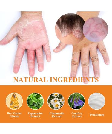 Bee Venom Cream for Psoriasis Cream Bee Venom Cream Psoriasis Treatment New Zealand Bee Venom Chinese Herbal Cream for Psoriasis Bee Venom Psoriasis Soothing Itching 20g (2) - Buy Online on SooperMarket.com