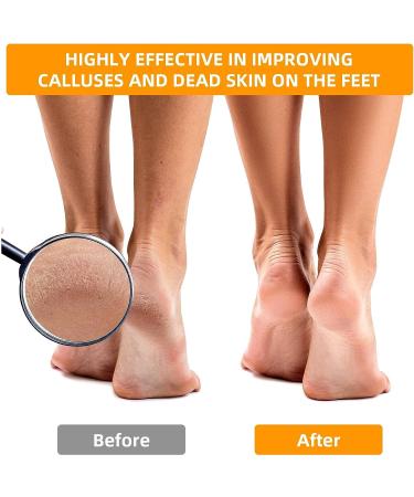 12 PCS Stainless Steel Foot Grater Set - Professional Callus Remover for Feet - Buy Online on SooperMarket.com