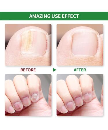 Nail Fungus Treatment For Toenail - Extra Strong Fungal Nail Treatment - Anti fungus Nail Repair and Strengthen Fix & Renew Damaged Broken Nails (2PC) - Buy Online on SooperMarket.com