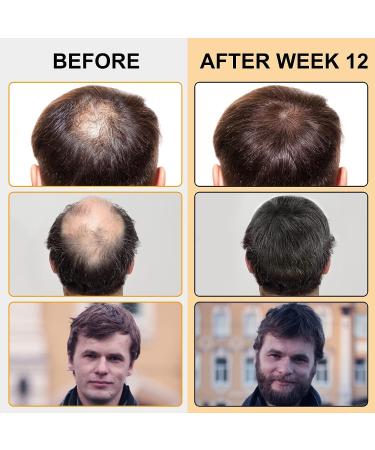 5% Minoxidil Foam Hair Regrowth Treatment for Men & Women - Stops Hair Loss, Promotes Follicle Growth - 2.11fl oz - Buy Online on SooperMarket.com
