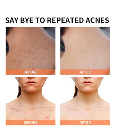 Salicylic Acid Acne Treatment Cream for Face & Body - Teens & Adults | Anti-Acne Moisturizer & Spot Treatment - Buy Online on SooperMarket.com