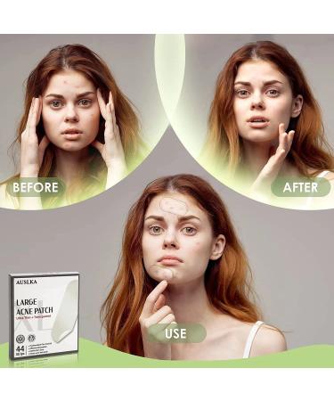 AUSLKA XL Blemish Acne Pimple Patches (44 Strips) - Hydrocolloid Spot Dots for Large Blemishes - Pimple Stickers for Larger Areas - Buy Online on SooperMarket.com
