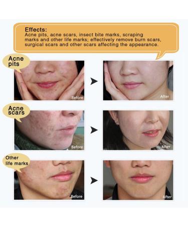 3 Pack TCM Scar Removal Cream - Scar Reducing Treatment for Stretch Marks, Acne Scars, Surgical Scars - 1.1 Ounce (Pack of 3) - Buy Online on SooperMarket.com