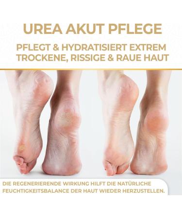 Fallea 25% Urea Acute Foot Cream 200ml - Intensive Moisturizing Foot Care & Corneal Remover for Dry Skin Cracks & Itching - Buy Online on SooperMarket.com