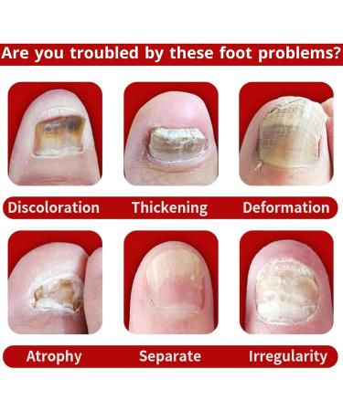 TBeautfave Fungal Nail Treatment Antifungal Nail Treatment Toe Nail Fungal Treatment Fungal Nail Treatment for Toenails Extra Strong Nail Repair and Strengthen Fix & Renew Damaged Broken Nails - Buy Online on SooperMarket.com