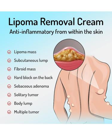 Lipoma Removal Cream 20g - Natural Treatment for Lipoma Care & Discomfort - Buy Online on SooperMarket.com
