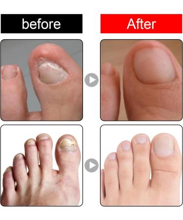 Ingrown Toenail Treatment - 30ml Ingrown Toenail - Cuticle Care Oils for Ingrown Toenails - Trimming Toenail Softening Drops Natural Ingrown Toenail Correction Treatment Fungal Nail Treatment - Buy Online on SooperMarket.com
