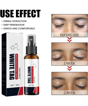 Likmind Kolmax Psoriasis Relief Spray - 30ml Dermax Treatment for Itching and Clear Skin (2 Pack) - Buy Online on SooperMarket.com