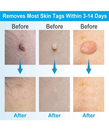 Painless 2-in-1 Skin Tag Removal Kit for Micro to Large Skin Tags (1-9mm) - Safe & Easy DIY Tool for Home Use - Buy Online on SooperMarket.com