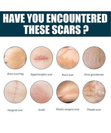 Stretch Mark Gel 2Pcs 50ml with Allantoin & Vitamin E - Hydrating Scar Remover for Scars, Burns & Surgery - Buy Online on SooperMarket.com