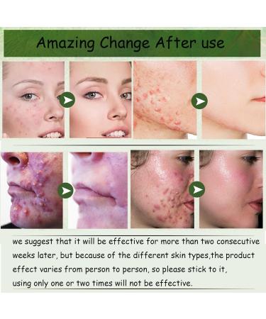 Acne Cream Moisturiser Face Cream Spot Cream Mens Moisturiser Tea Tree Cream Spot Cream For Acne Cream Moisturiser for Women Men Teenagers Dilute Face Prone Spot Marks Balance Facial Oil Cream - Buy Online on SooperMarket.com