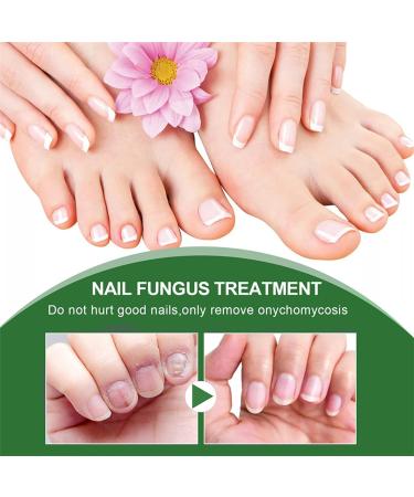 Nail Fungus Treatment For Toenail - Extra Strong Fungal Nail Treatment - Anti fungus Nail Repair and Strengthen Fix & Renew Damaged Broken Nails (2PC) - Buy Online on SooperMarket.com