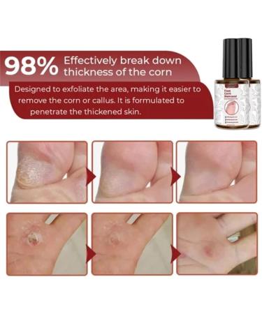 Xebular Foot Corn Removal Gel - Extra Strength Liquid for Toes - Callus & Corn Remover (3 PCS) - Buy Online on SooperMarket.com