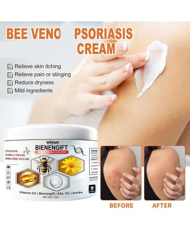 Bee Venom Psoriasis Cream Bee Venom Cream for Psoriasis New Zealand Bee Venom Body Care Chinese Herbal Cream Soothing Psoriasis Cream Body Cream for Redness & Itching & Soothing (1) - Buy Online on SooperMarket.com