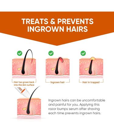 Ingrown Hair Treatment & Razor Bumps Stopper Serum - Alcohol-Free After Shave Solution for Men and Women - Face, Neck, Bikini, Legs, and Underarms - Buy Online on SooperMarket.com