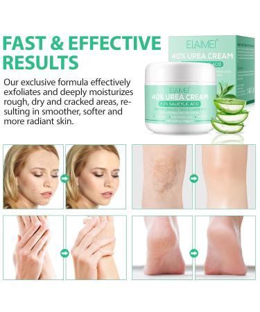 Urea Cream 40% with 2% Salicylic Acid - Best Callus Remover & Foot Repair Lotion for Dry Cracked Heels Knees & Hands (5.29 OZ) - Deep Moisturization & Skin Renewal - International Shipping Available - Buy Online on SooperMarket.com