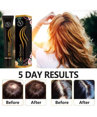 Hair Growth Serum for Men & Women | Boost Hair Growth Treat Hair Loss & Achieve Full Hair - 20ml - Buy Online on SooperMarket.com