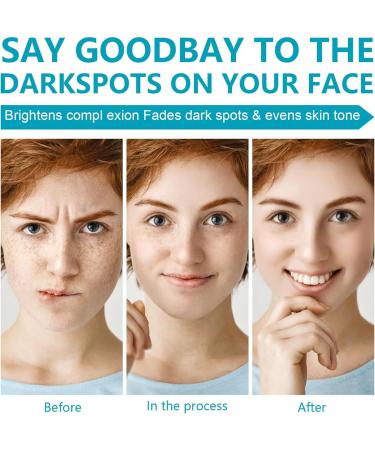Dark Spot Remover for Face & Body Dark Spot Remover Dark Spot Corrector Cream Hyperpigmentation Treatment Freckle Removel Cream Spot Cream for All Skin Types 50 ml /1.7 fl oz - Buy Online on SooperMarket.com
