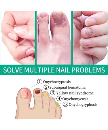 2Pack Kerassentials Toenail Oil and Skin Treatment Set for Nail Care - Buy Online on SooperMarket.com