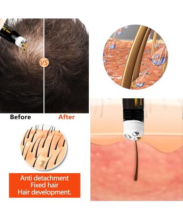 Hair Growth Serum for Men & Women | Boost Hair Growth Treat Hair Loss & Achieve Full Hair - 20ml - Buy Online on SooperMarket.com