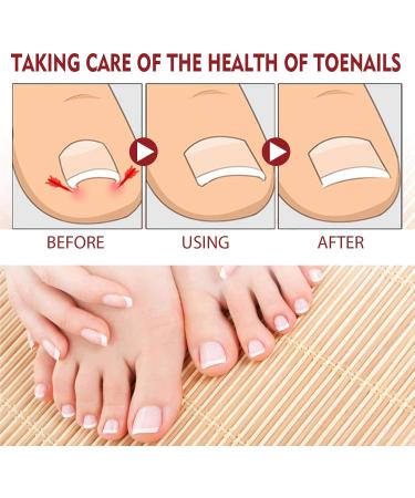 Ingrown Toenail Treatment Correction Drops Nail Growth Treatment Nail Care Ingrowing Toenail Treatment Ingrown Toenail Corrector Treatment for Ingrown Toenail Ingrowing Toenail Improve Toenail Health - Buy Online on SooperMarket.com