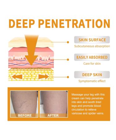 Vitamin K Cream for Varicose Veins - Miracle Cream for Spider Veins & Leg Vein Removal (1pcs) - Fast International Shipping - Buy Online on SooperMarket.com