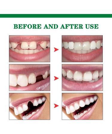 Funnaura Teeth Filling Repair Kit Permanent with Tweezers Temporary Tooth Filler for Missing Broken Fake Chipped Toothy - Buy Online on SooperMarket.com
